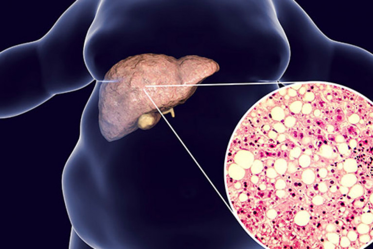 Dietary Supplements for NAFLD