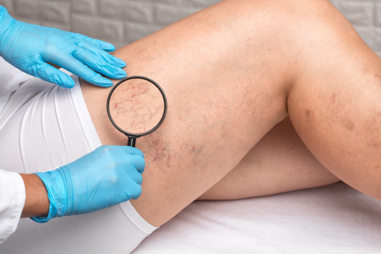 Top Supplements for Vein Health